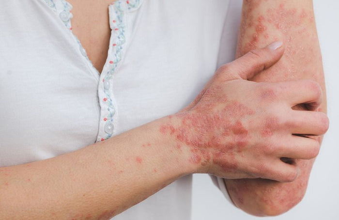 Si vous souffrez de psoriasis, cet article pourrait vous intéresser