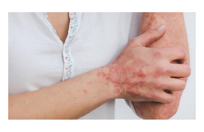 CBD et psoriasis : quelle efficacité ?